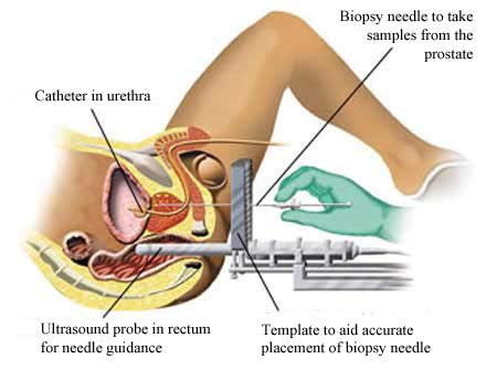 prostate and prostate biopsy