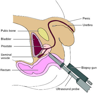 Biopsy on prostate