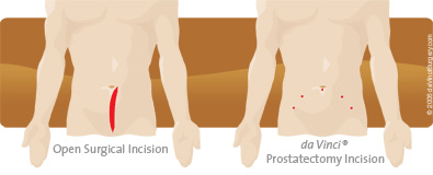 robotic-prostatectomy-incisions