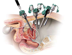 roboticprostatectomyprocedure